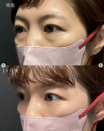CLINIC Wの目元・クマ・眉下・涙袋整形の症例写真