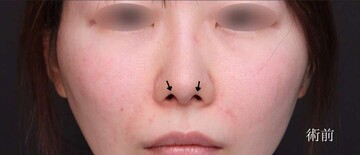 聖心美容クリニックの鼻の症例写真[ビフォー]