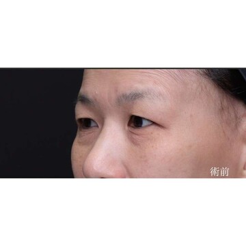 聖心美容クリニックの目元の症例写真[ビフォー]