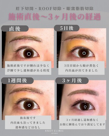 KNOT CLINIC AOYAMAの目元・クマ・眉下・涙袋整形の症例写真