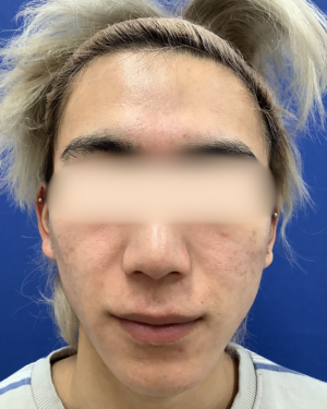 フェミークリニックのニキビ・ニキビ跡の治療の症例写真[ビフォー]