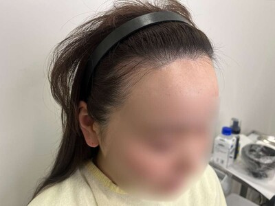 ヘアアートメイク｜30代｜2回の症例写真[ビフォー]