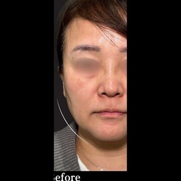 PRISM Beauty Clinicのリフトアップの症例写真[ビフォー]