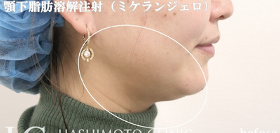 脂肪溶解注射ミケランジェロの症例写真[ビフォー]