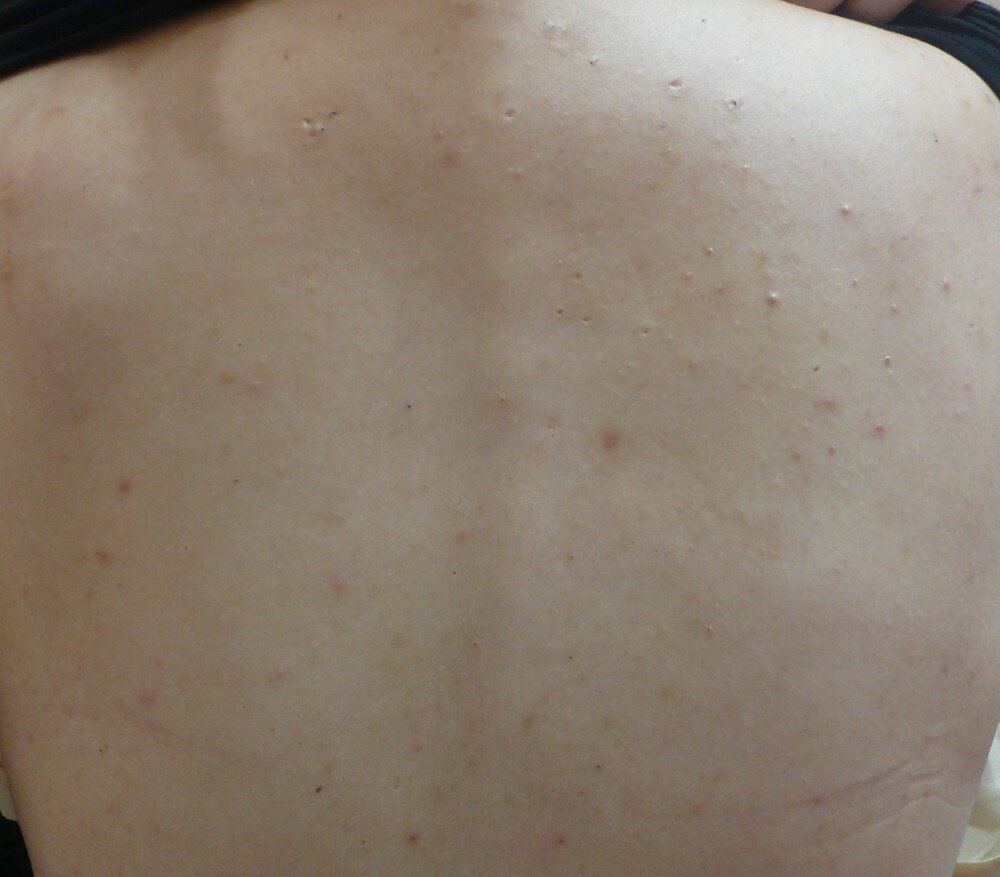 背中ニキビ改善 その他 ニキビ治療 の症例写真 画像 広島プルミエクリニック Cs 美容医療の口コミ広場