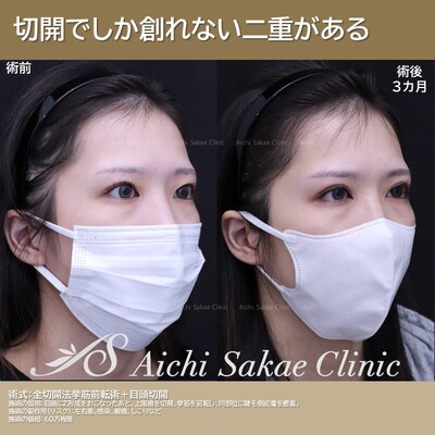 切開でしかつくれない二重があるの症例写真