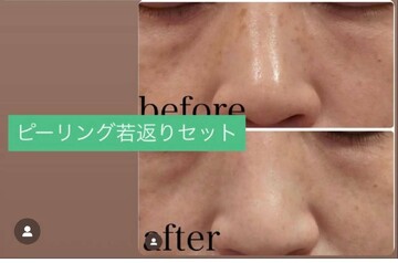 やさしい美容皮膚科・皮フ科 秋葉原院/シミレーザー東京のシミ・肝斑の症例写真