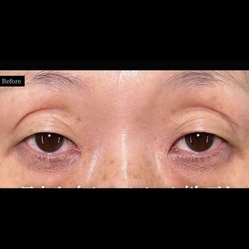 PRISM Beauty Clinicの二重の症例写真[ビフォー]