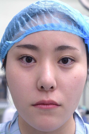 医療法人秀晄会 心斎橋コムロ美容外科クリニックの輪郭・顎・エラ・額・小顔整形の症例写真[ビフォー]