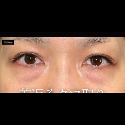 若返るクマ取り💡の症例写真[ビフォー]