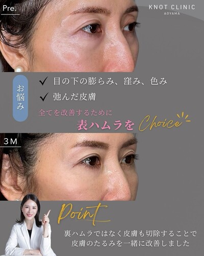 何歳からでも遅くないクマ治療【表ハムラ】の症例写真