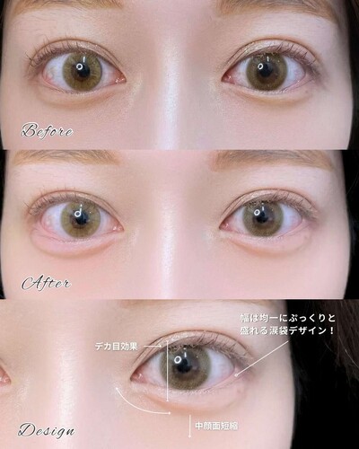 涙袋のヒアルロン酸注入の症例写真