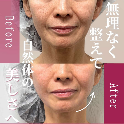 アルテミスリフト（PLLA）4本の症例写真