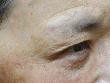 しわボトックス（目尻）の症例写真[アフター]