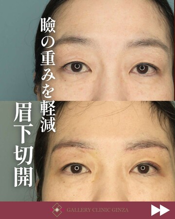 ギャラリークリニックの目元・クマ・眉下・涙袋整形の症例写真
