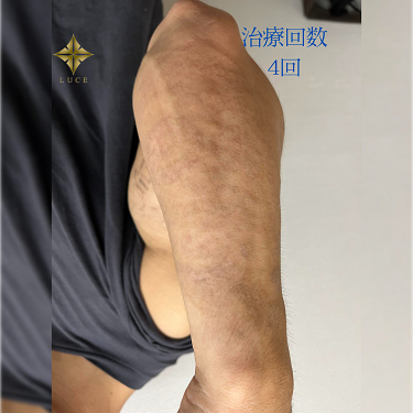 前腕のタトゥー除去の症例写真[アフター]