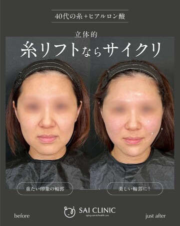 SAI CLINIC （サイクリニック）のリフトアップの症例写真