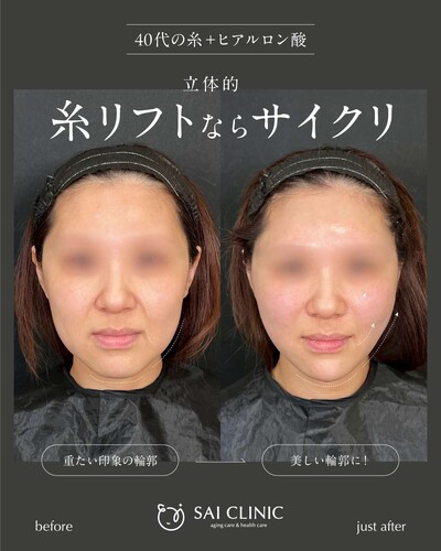 糸リフト：14本＋ ヒアルロン酸：5ccの症例写真