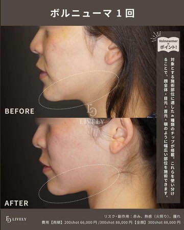 LIVELY CLINIC 浜松町院のしわ・たるみ整形(注入、糸、フェイスリフト)の症例写真
