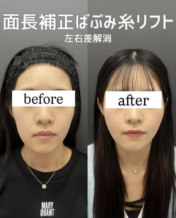 Plume Clinicのしわ・たるみ整形(注入、糸、フェイスリフト)の症例写真