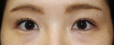 二重まぶた　切開法の症例写真