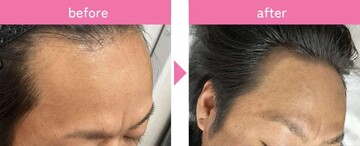タイムルクリニックの薄毛治療の症例写真