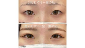 SAI CLINIC （サイクリニック）の二重の症例写真