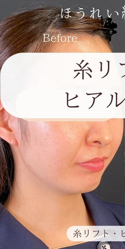 糸リフトとヒアルロン酸の症例写真[ビフォー]