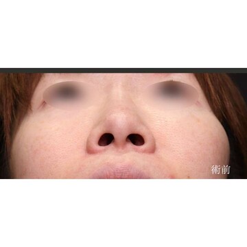 聖心美容クリニックの鼻の症例写真[ビフォー]