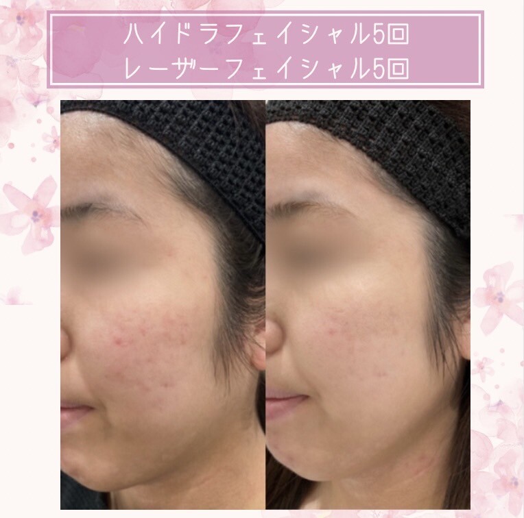 [20代 女性] ハイドラフェイシャル5回 レーザーフェイシャル5回（ニキビ・ニキビ跡の治療）の症例写真 (CS73681)｜さっぽろ美容 ...