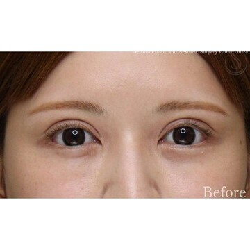 聖心美容クリニックの二重の症例写真[ビフォー]
