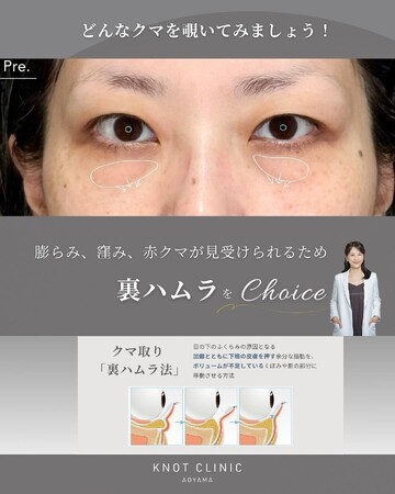 KNOT CLINIC AOYAMAの目元・クマ・眉下・涙袋整形の症例写真
