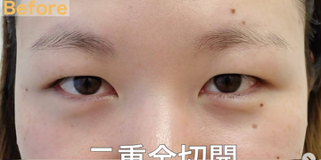 さかえ皮フ科クリニック（旧：ニドークリニック名古屋）の目・二重整形の症例写真[ビフォー]