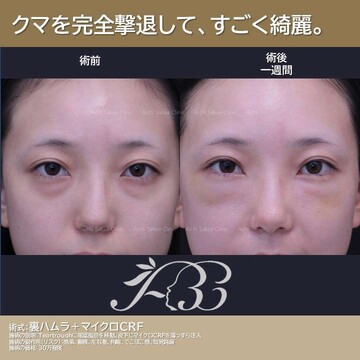 あいちビューティークリニック栄本院の目元・クマ・眉下・涙袋整形の症例写真