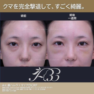 どんな表情でも魅せる裏ハムラ  の症例写真