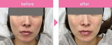 タイムルクリニックのしわ・たるみ整形(注入、糸、フェイスリフト)の症例写真