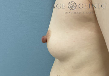 エースクリニックグループの乳首・乳輪の整形の症例写真[ビフォー]