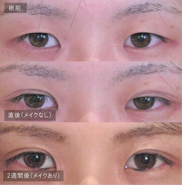 アーティスクリニックの目・二重整形の症例写真