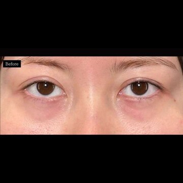 PRISM Beauty Clinicの目元の症例写真[ビフォー]