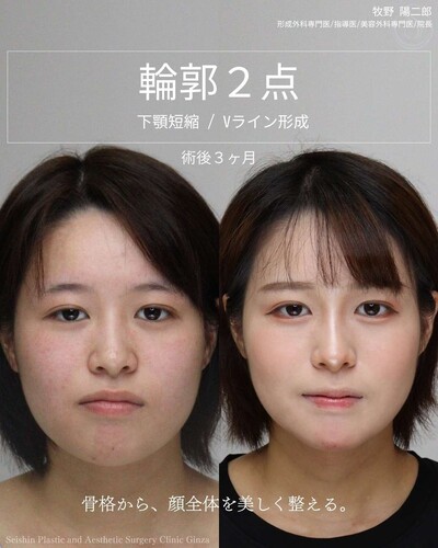 下顎短縮とVライン形成で輪郭をシャープにの症例写真