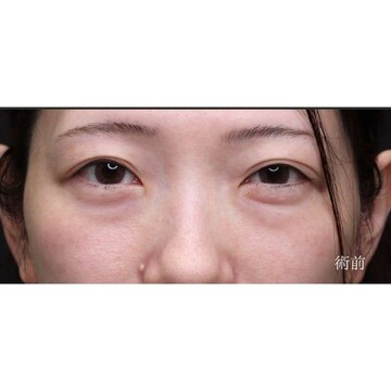 聖心美容クリニックの目元の症例写真[ビフォー]