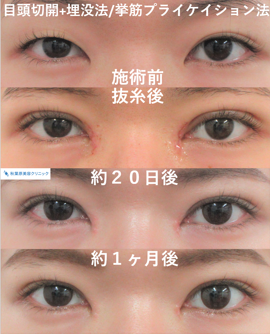 目頭切開 埋没挙筋プライケイション法 目 二重整形の症例写真 画像 秋葉原美容クリニック Cs 美容医療の口コミ広場