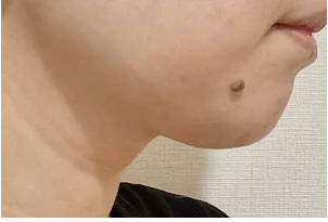 ペルラクリニック神宮前の症例写真[アフター]