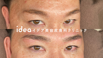 イデア美容皮膚科クリニックのアートメイクの症例写真