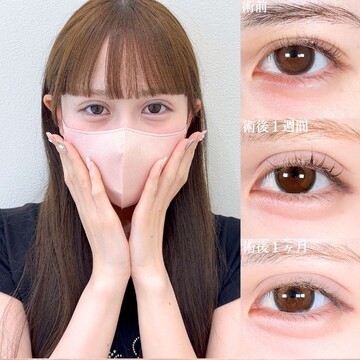 アリエル美容クリニック 大宮院の二重の症例写真