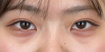 AI Beauty Clinicの目元・クマ・眉下・涙袋整形の症例写真[ビフォー]