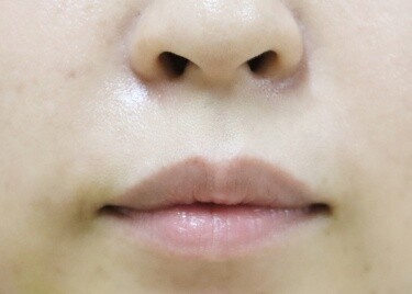 口角ボトックスの症例写真[アフター]