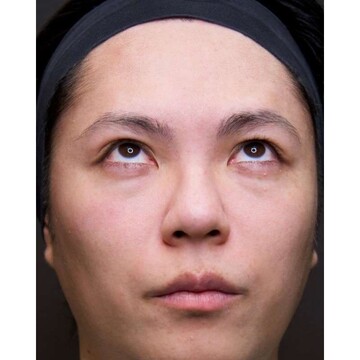 聖心美容クリニックの目元の症例写真[ビフォー]