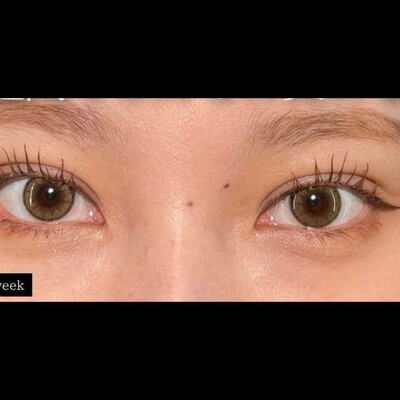 プリズムの二重、1週間で変わる😎の症例写真[アフター]
