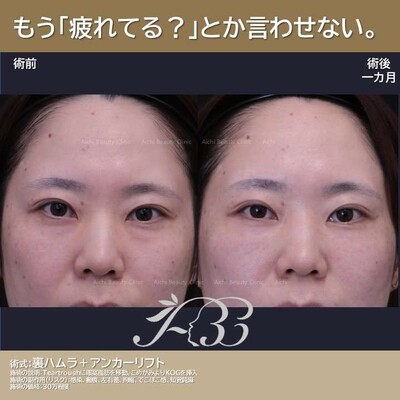 軽いクマでも治してみるとちゃんと若返るの症例写真